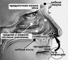 ✅ КАК БЫСТРО ВЫЛЕЧИТЬ НАСМОРК, СОПЛИ, ПРОСТУДУ. ...Если вы или ваши дети...